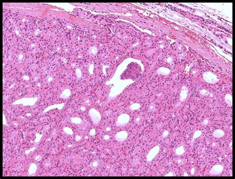 FNAC (Fine needle aspiration cytology) and histopathological ...