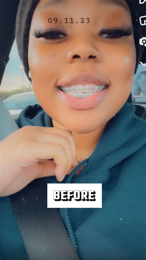 Jaw surgery ruined my face (before/after) : r/jawsurgery