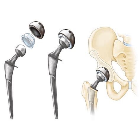 Hip Replacement Surgery in Tanda | Hip Replacement Surgeon