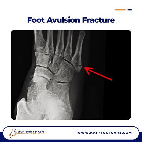Avulsion Fracture Foot