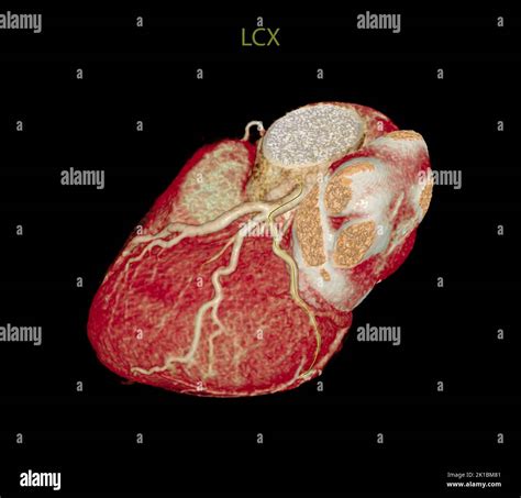 CT Cardiac 3D or CTA coronary artery for prevention coronary artery diseases Stock Photo - Alamy