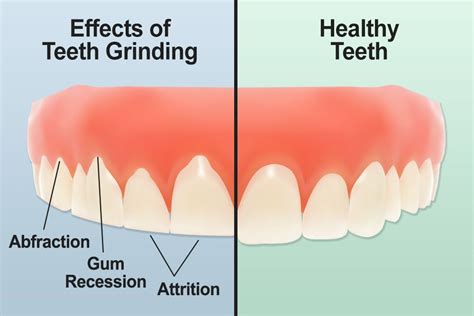 Image result for teeth grinding