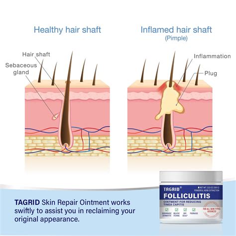 TAGRID Folliculitis Treatment Cream - Fast & Safe Relief for Severe Folliculitis & Lichen - 100g ...