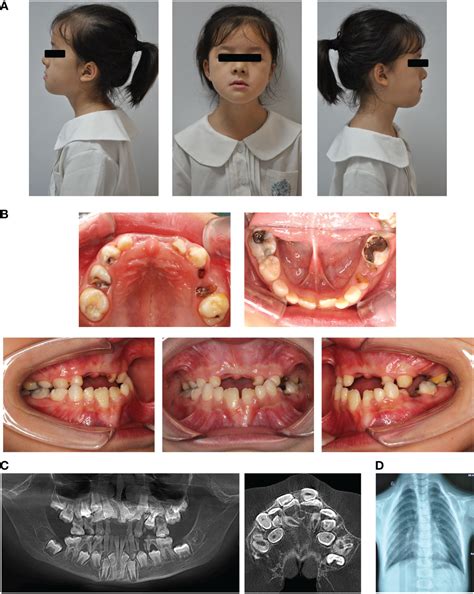 Frontiers | Amyloid-mediated remineralization for tooth hypoplasia of cleidocranial dysplasia