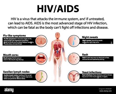 Early Hiv Aids Symptoms