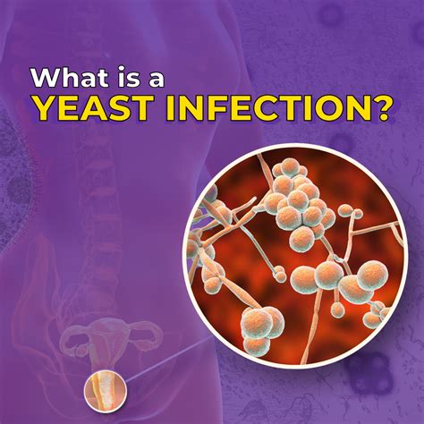 Can Estriol Cause Yeast Infections?