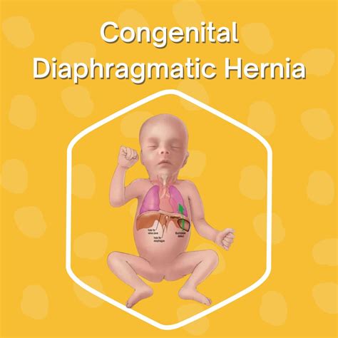 Congenital Diaphragmatic Hernia