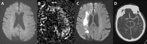 Image result for Contralateral Homonymous Hemianopsia