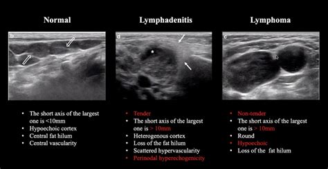 Lymph Node Ultrasound