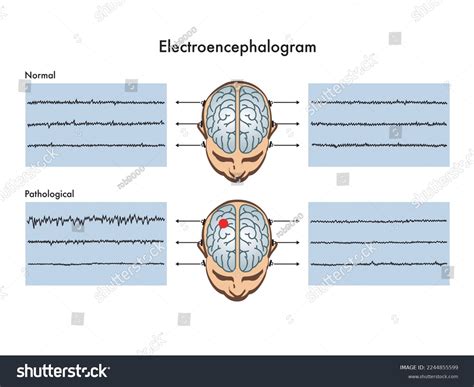 Electroencephalogram Medical Terminology Breakdown at Leah Woodcock blog