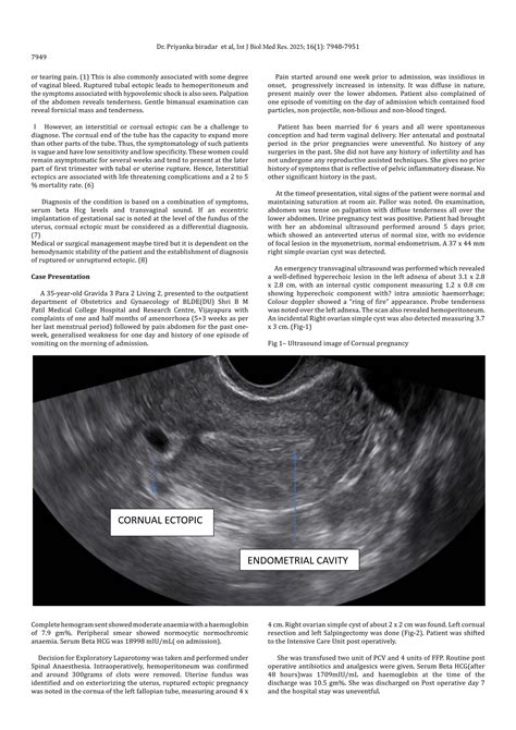 Cornual Ectopic Pregnancy A rare case report.pdf