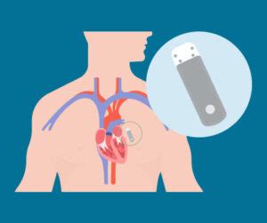 Removing a Loop Recorder 的图像结果