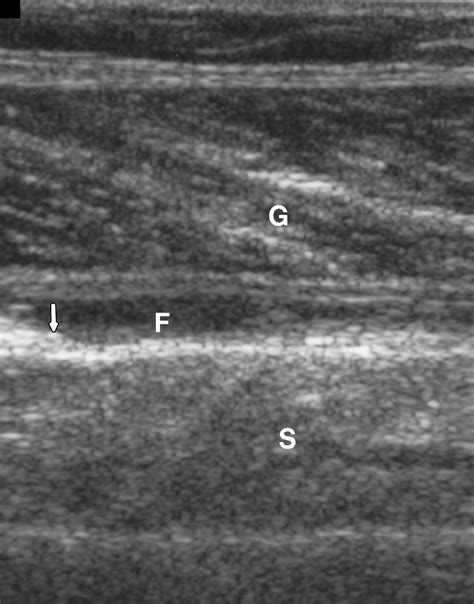 Gastrocnemius Tear Ultrasound