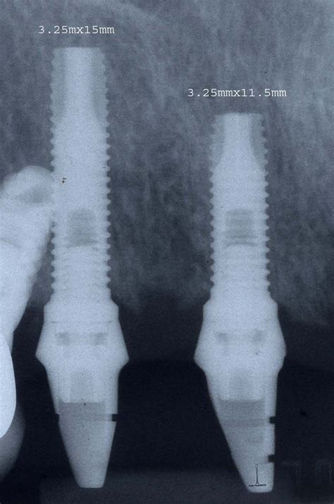 Biomet 3i Parallel Walled (Regular) Implante dental | SpotImplant