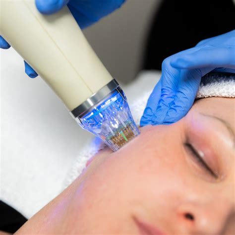 RF Microneedling Treatment in Chandigarh | Panache Skin Clinic