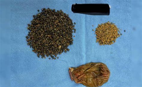 गुरुग्राम : मरीज के गॉल ब्लैडर से निकाली गई 8125 पथरी, स्टोन को गिनने ...