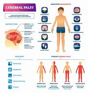 Image result for palsy