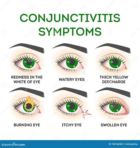 Conjunctivitis Symptoms. Pink Eye Disease, Infection and Allergy Stock Vector - Illustration of ...