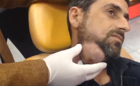 Image result for Worst Exploding Pimple