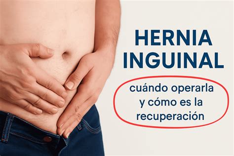 Hernia inguinal: cuándo operarla y cómo es la recuperación - Dr. Santiago Mera