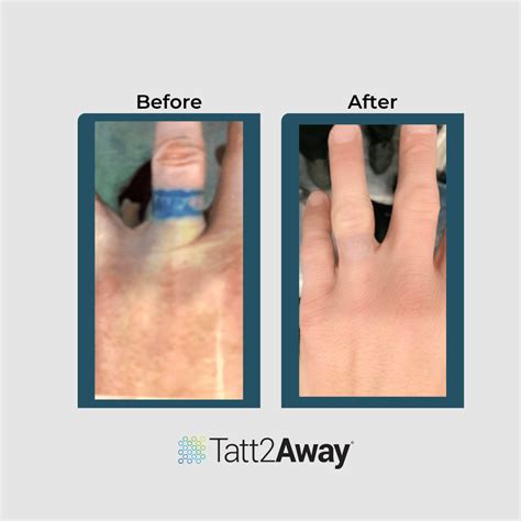 New Hampshire Locations - Tattoo Removal Services by Tatt2Away