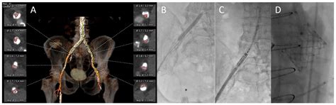 Intravascular Lithotripsy-Assisted Transfemoral Transcatheter Aortic ...