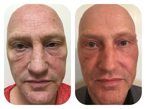 Best CO2 Laser Skin Resurfacing in Dallas at Advanced Skin Fitness Medspa