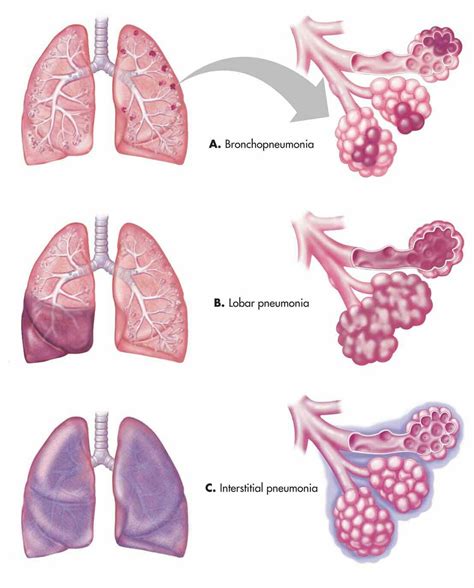 Types of pneumonia | Medical anatomy, Medical school essentials, Pneumonia