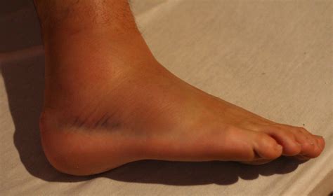 Sprained Ankle - Runner's Guide to Diagnosis, Treatment & Prevention