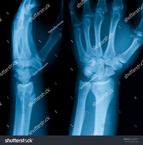 X Ray Wrist Lateral View