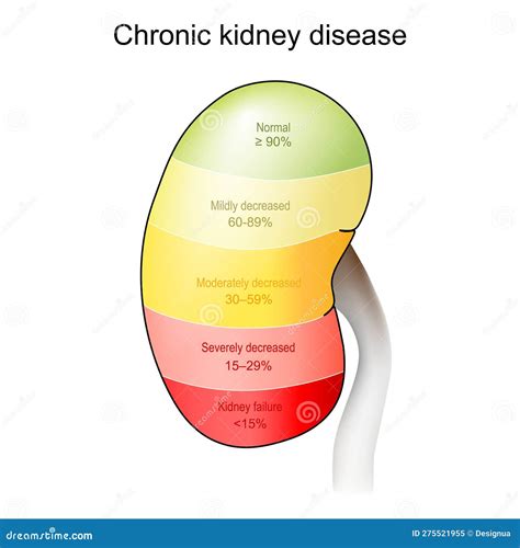 Chronic Kidney Disease. Stage of Disorder Stock Vector - Illustration of dialysis, filter: 275521955