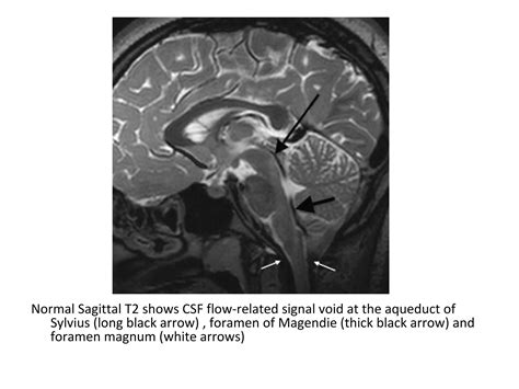 Diagnostic Imaging of Hydrocephalus & Pneumocephalus | PPT