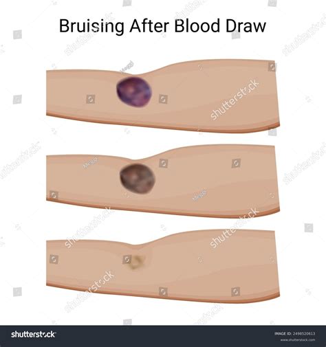 Healing Bruise Progression Post Blood Draw Stock Vector (Royalty Free ...