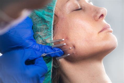 Thread lifts – Ziva Skin and Hair care center