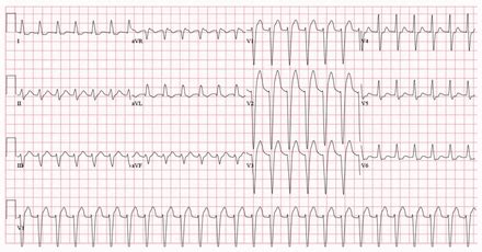 Image result for AFib Detection Algorithm