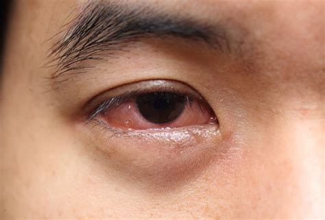 What Causes Mucus in Eye (Eye Discharge) and How to Get Rid of It?