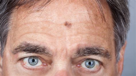 Lentigo maligna – ist die Exzision immer die beste Wahl für die Patien ...