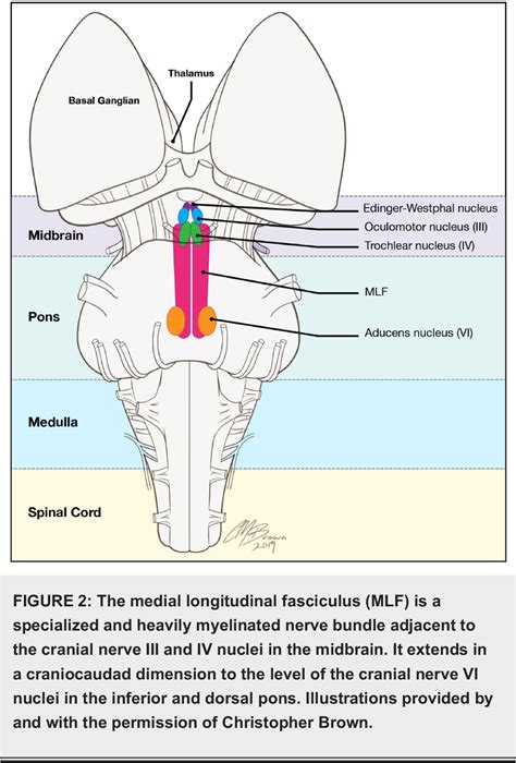Figure 2 from The Medial Longitudinal Fasciculus and Internuclear ...