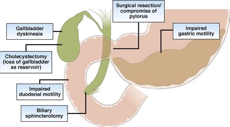 New Causes for the Old Problem of Bile Reflux Gastritis - Clinical Gastroenterology and Hepatology