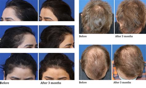 Female Hair Loss Treatment Prp at Zane Stirling blog