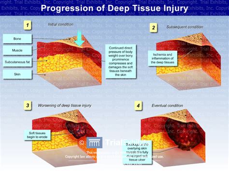 Image result for Deep Tissue Injuries
