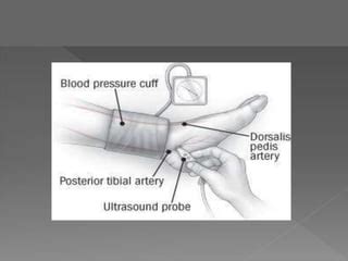 Ankle-Brachial Index Procedures Using Unit IX 的图像结果