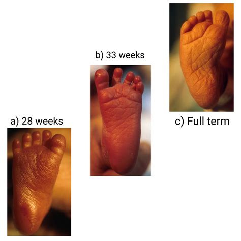 Preterm Infant's impairments and complications
