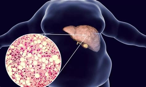 Updated MASLD Guidelines Emphasize New Strategies for Managing Liver ...