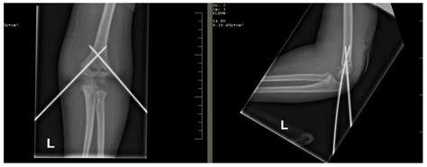 Modern Treatment of Supracondylar Humeral Fractures in Children