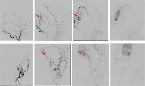 Image result for AVM Brain