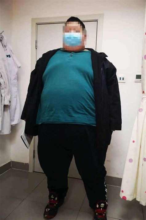 生怕活不到30岁的500斤巨胖加，减重手术完美收工