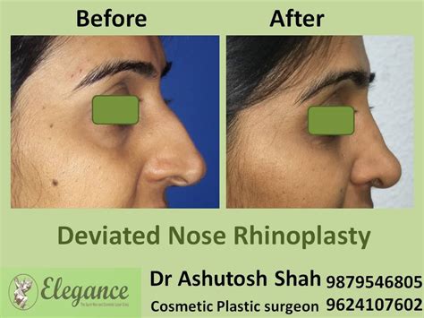 Deviated Nasal Septum in Bhilwara, Rajasthan, India