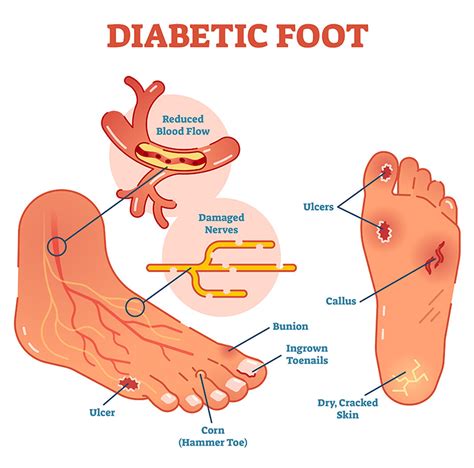 Diabetic Wound Care | Mitra Tabassian DPM | Podiatrist In Inglewood, CA