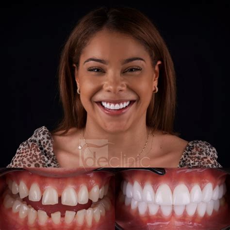 How much are Veneers in Turkey? - Dental Excellence Turkey Blog : Dental Excellence Turkey Blog
